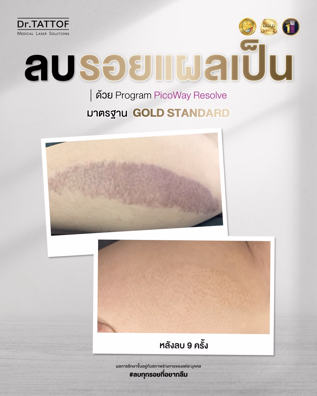 Dr.TATTOF เปิดตัว Scar Clinic ครบวงจร ตอกย้ำความเชี่ยวชาญด้านการรักษาแผลเป็น